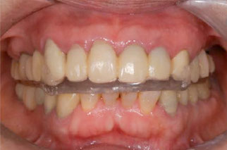 スプリントを装着