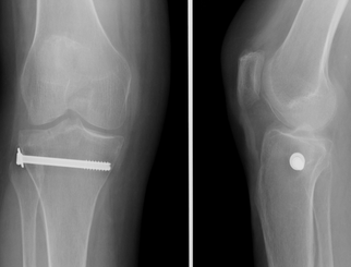 ostéosynthèse fracture plateau tibial percutanée chirurgie orthopedique sportive dr Rémi Toulouse La croix du Sud