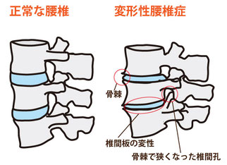 変形性腰椎症絵図