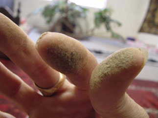 resine de cannabis pur comme medicament