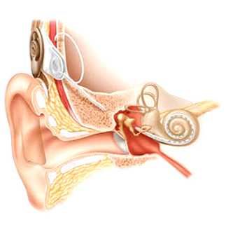 Das Cochlea Implantat - eine elektronische Hörprothese