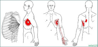 前鋸筋トリガーポイントは息切れ,喘息症状