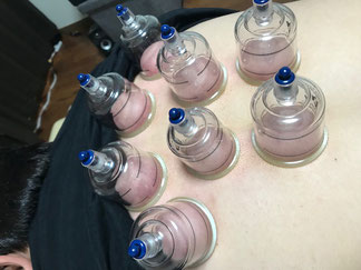 小牧 鍼灸 吸い玉 腰痛 肩こり 背中の痛み