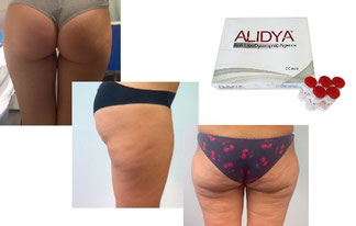 cellulite in Alessandria. i vari stadi dell'evoluzione