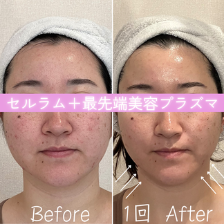 セルラム　ビフォーアフター