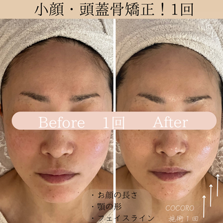 小顔リフト　ビフォーアフター