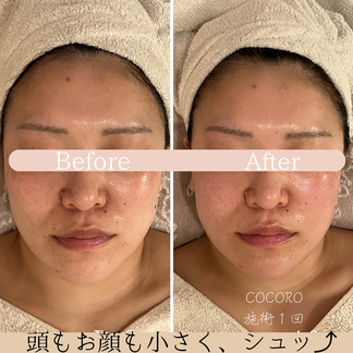 小顔リフト　ビフォーアフター