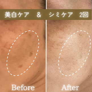 シミケア・美白　ビフォーアフター