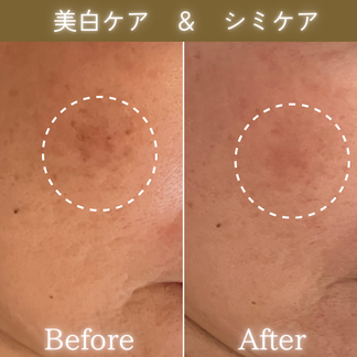 シミケア ビフォーアフター