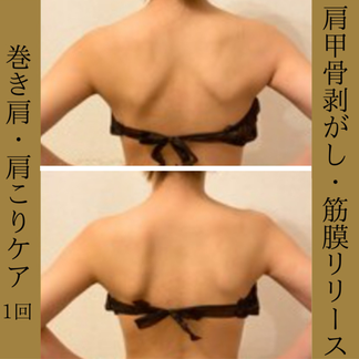肩甲骨はがし ビフォーアフター