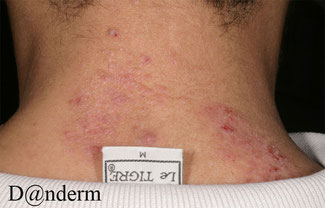 Plaque d'eczema du au frottement de l'etiquette