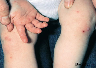 Syndrome pied main bouche