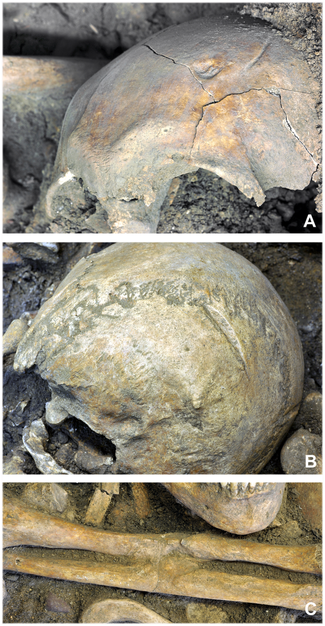(A) Deux blessures guéries, (B) Blessure avec des traces de cicatrisation, (C) Blessure à l'avant bras qui a fait fusionner le radius et le cubitus