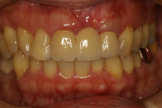 歯並びの改善