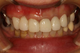 歯ぐきの再生治療