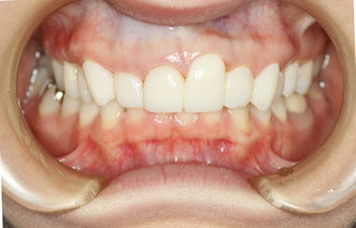 歯並びを審美歯科で治療