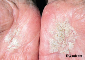 eczéma kératosique des paumes avec épaississement de la peau