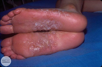 eczema bulleux