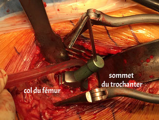 THA surgery Dr Rémi orthopaedic surgeon Clinic Capio Toulouse France
