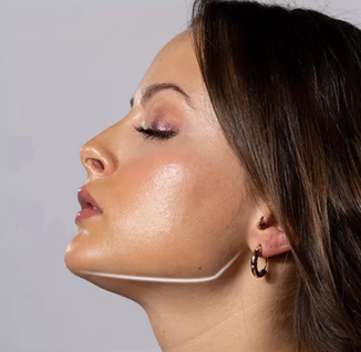 Straffung der Jawline und Kinnaufbau mit Radiesse