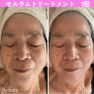 セルラム　ビフォーアフター