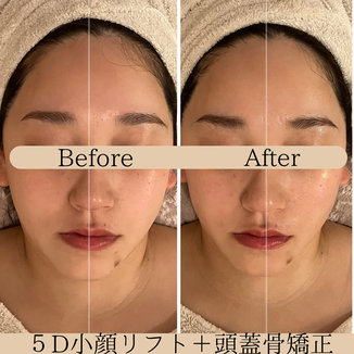 頭蓋骨矯正　ビフォーアフター