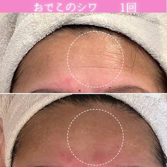 セルラム　ビフォーアフター