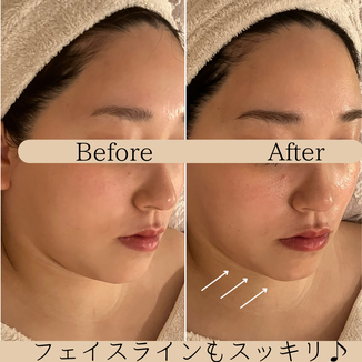 頭蓋骨矯正　ビフォーアフター