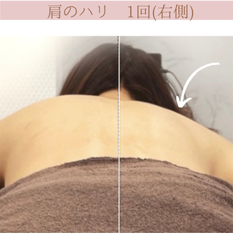 肩のハリケア　ビフォーアフター
