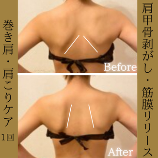 肩甲骨・巻き肩ケア　ビフォーアフター