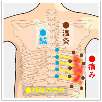 帯状疱疹後神経痛の施術図