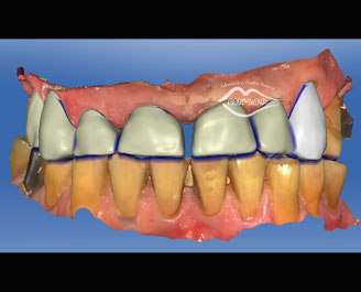 Cerec connect, empreinte optique, Full céramique