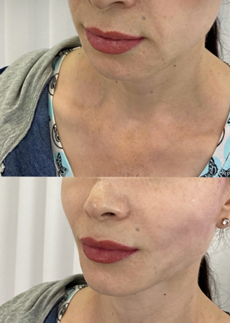 Straffung Kinn Jawline Wangenknochen ohne Hyaluron mit Radiesse 