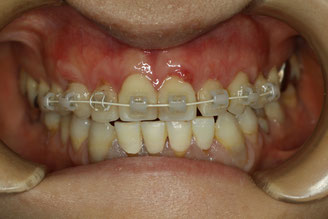 矯正治療後の歯茎の退縮