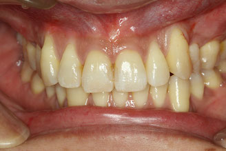 犬歯の歯茎再生