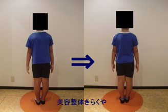 (結果には個人差があります。施術6回・期間2ヶ月)