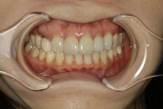 審美歯科で歯の形の修正