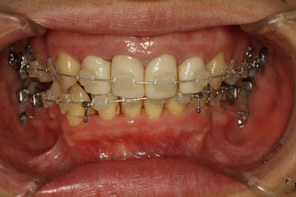 矯正中の仮歯