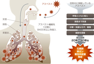 アスベストによる健康被害の解説