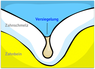 Fissurenversiegelung: Kein Platz mehr für Bakterien! (© wigerio)