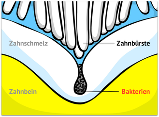 Die Zahnbürste erreicht die Bakterien nicht (© wigerio)