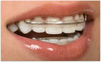 Wann ist der beste Zeitpunkt für eine KFO-Behandlung? Der Zahnarzt sagt es Ihnen! (© BVDC - CanStockPhoto Inc.)