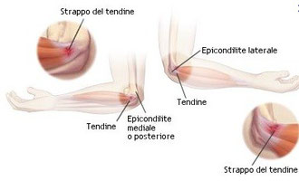 come curare l'epicondilite