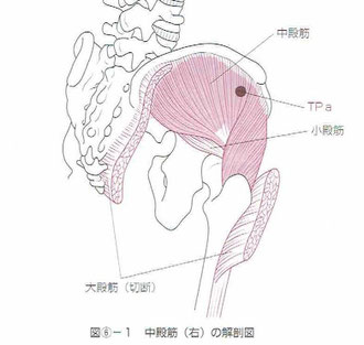 中殿筋のトリガーポイント
