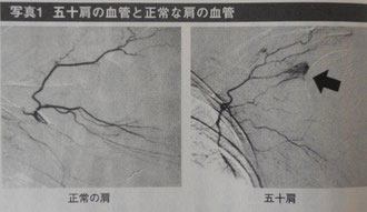 正常の肩と五十肩