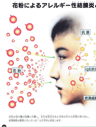 花粉によるアレルギー性結膜炎・アレルギー性鼻炎の起こる仕組み