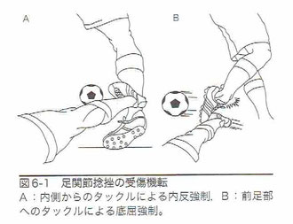 足関節捻挫の受傷機転