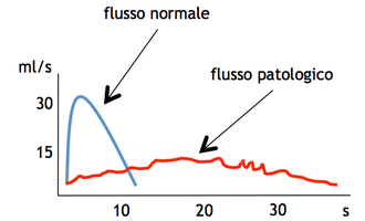 Esempio di tracciato dell'uroflussimetria