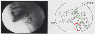 図９　嚥下中誤嚥