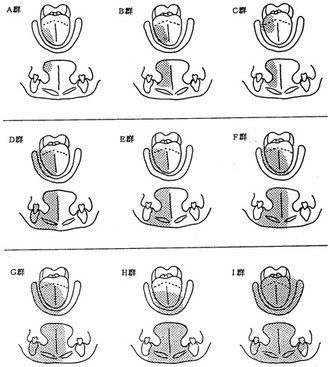図14 術式(切除の仕方)